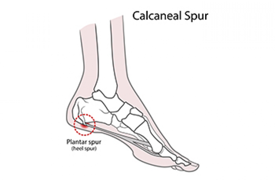 Heel pain (plantar fasciitis) — Active Foot Clinic | Wagga Wagga, Albury,  Bowral, Mittagong | Podiatrists and Shoe Stores