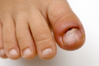 Toe Infections