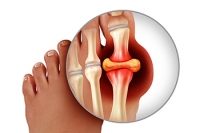 Definition and Common Symptoms of Gout