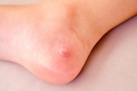 Risks for Foot Blisters